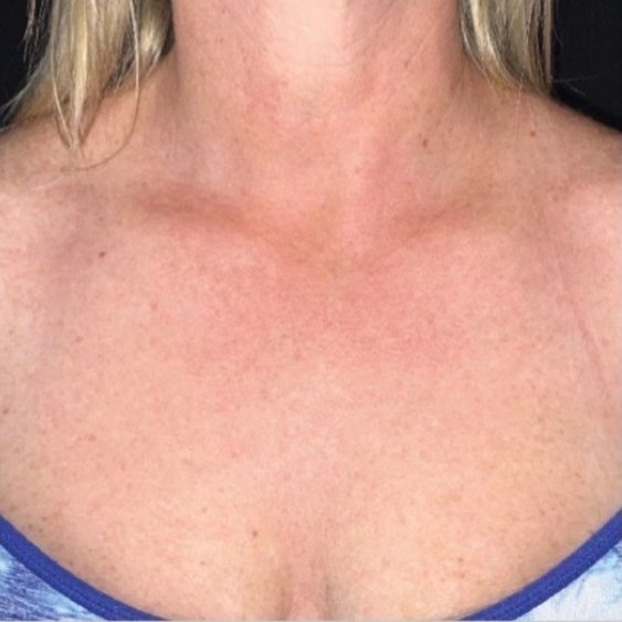 After BBL HEROic and Moxi treatment on body and chest