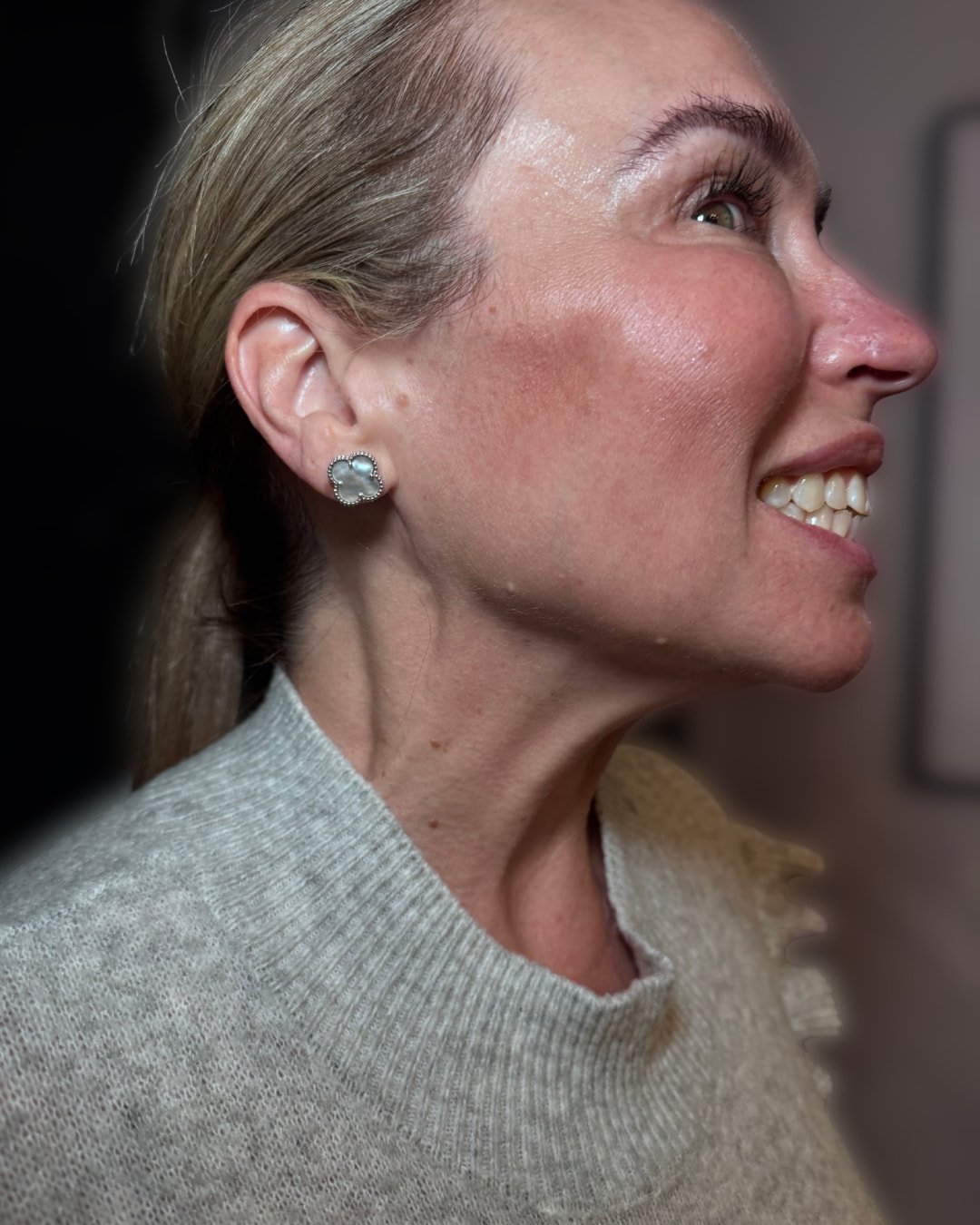 After Nefertiti neck lift