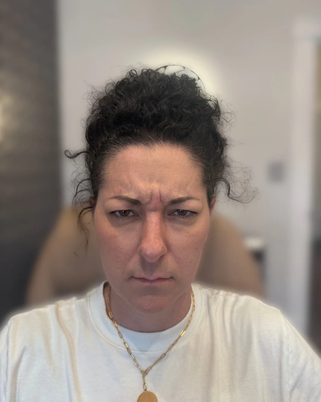 Jamie before Botox forehead treatment