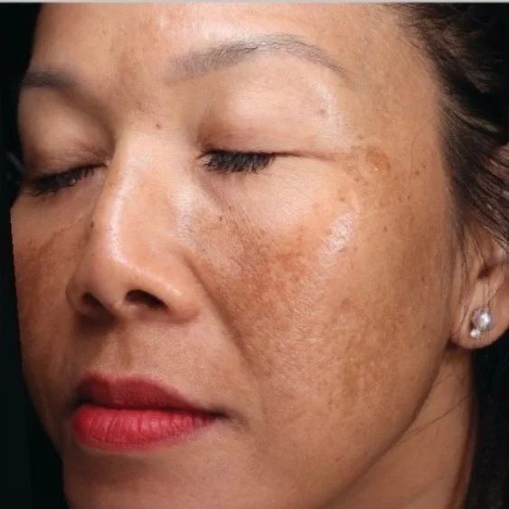 Before BBL HEROic and Moxi facial treatment