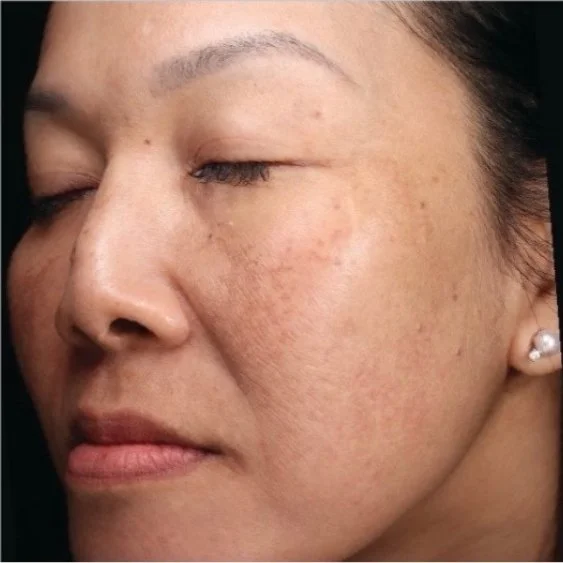 After BBL HEROic and Moxi facial treatment