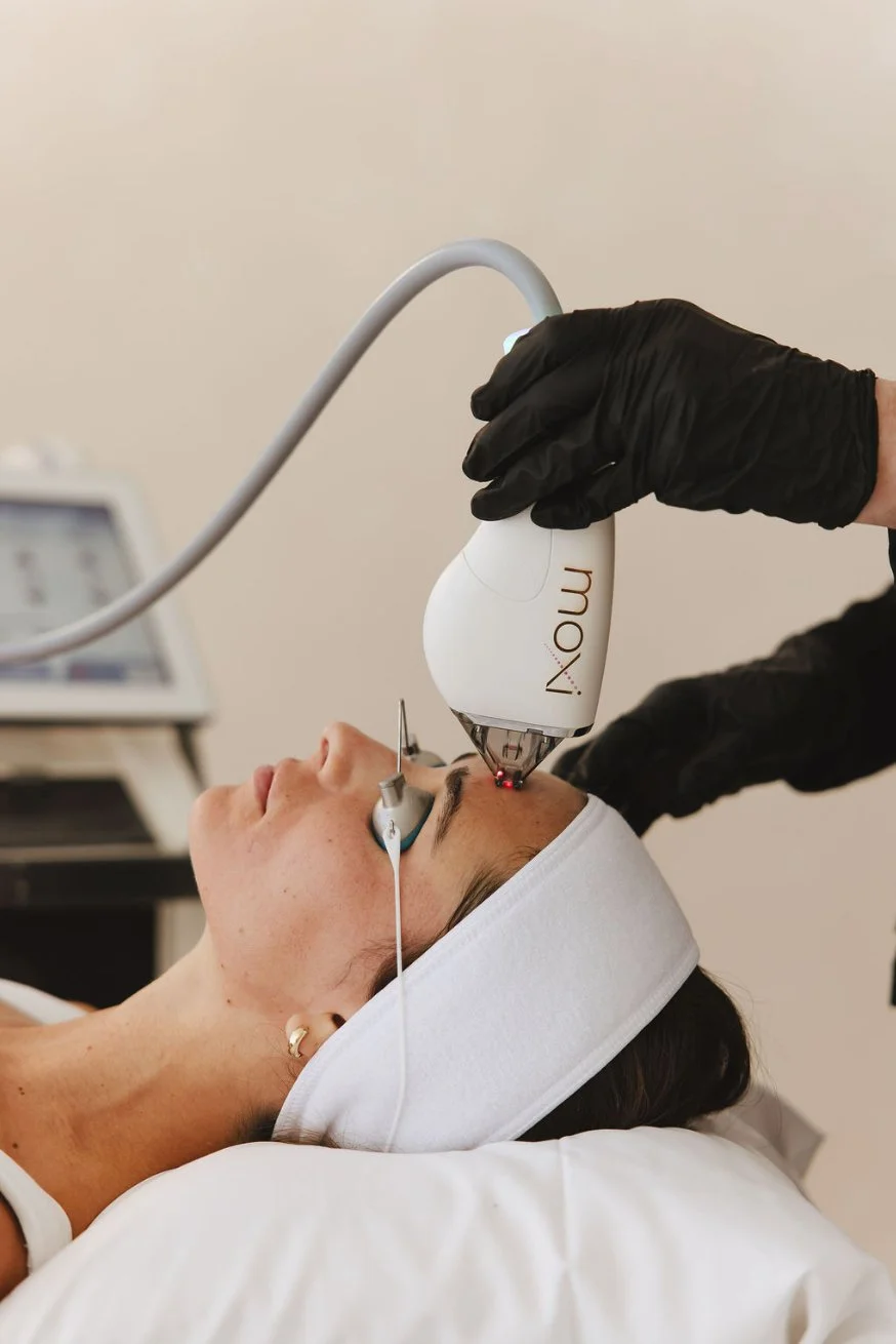 Moxi Laser treating forehead