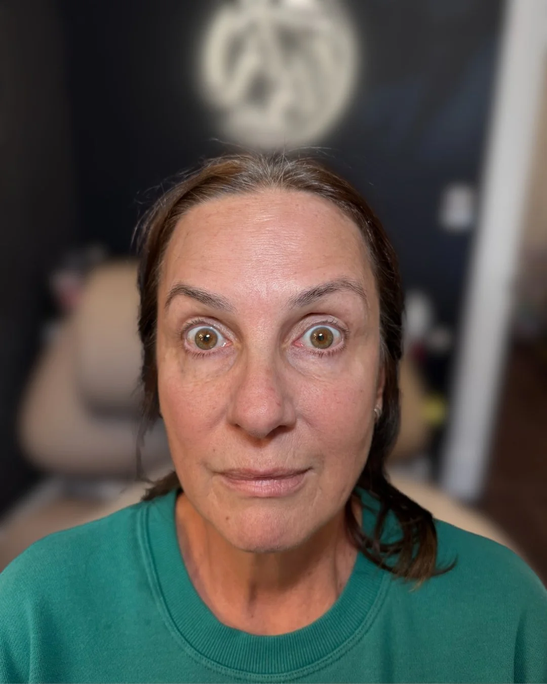 Before Botox forehead treatment