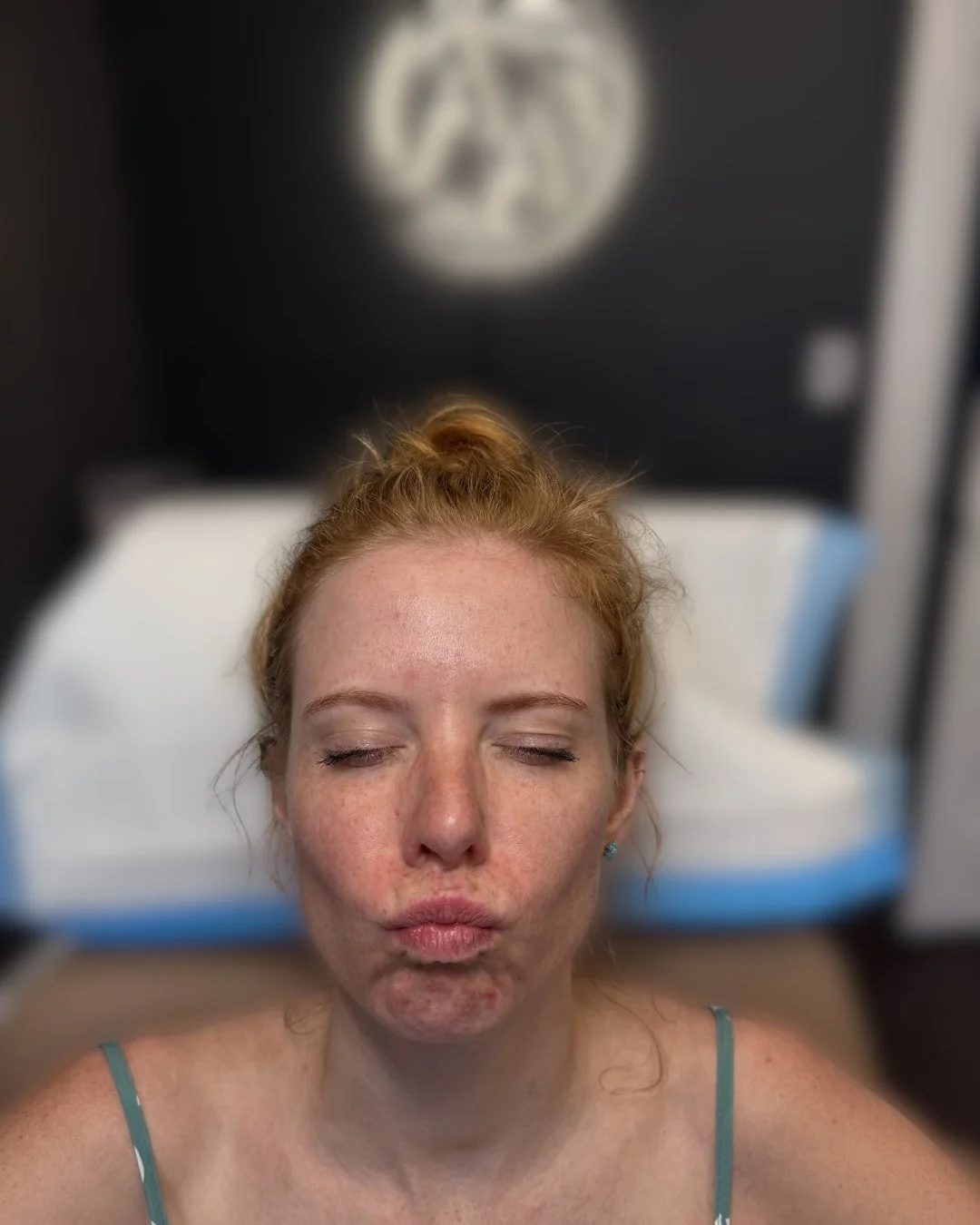 After Botox treatment