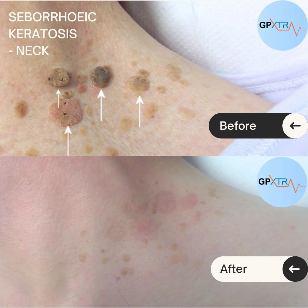 Seborrhoeic keratosis on the neck, before and after treatment