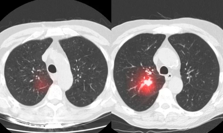 Future of Lung Cancer Screening