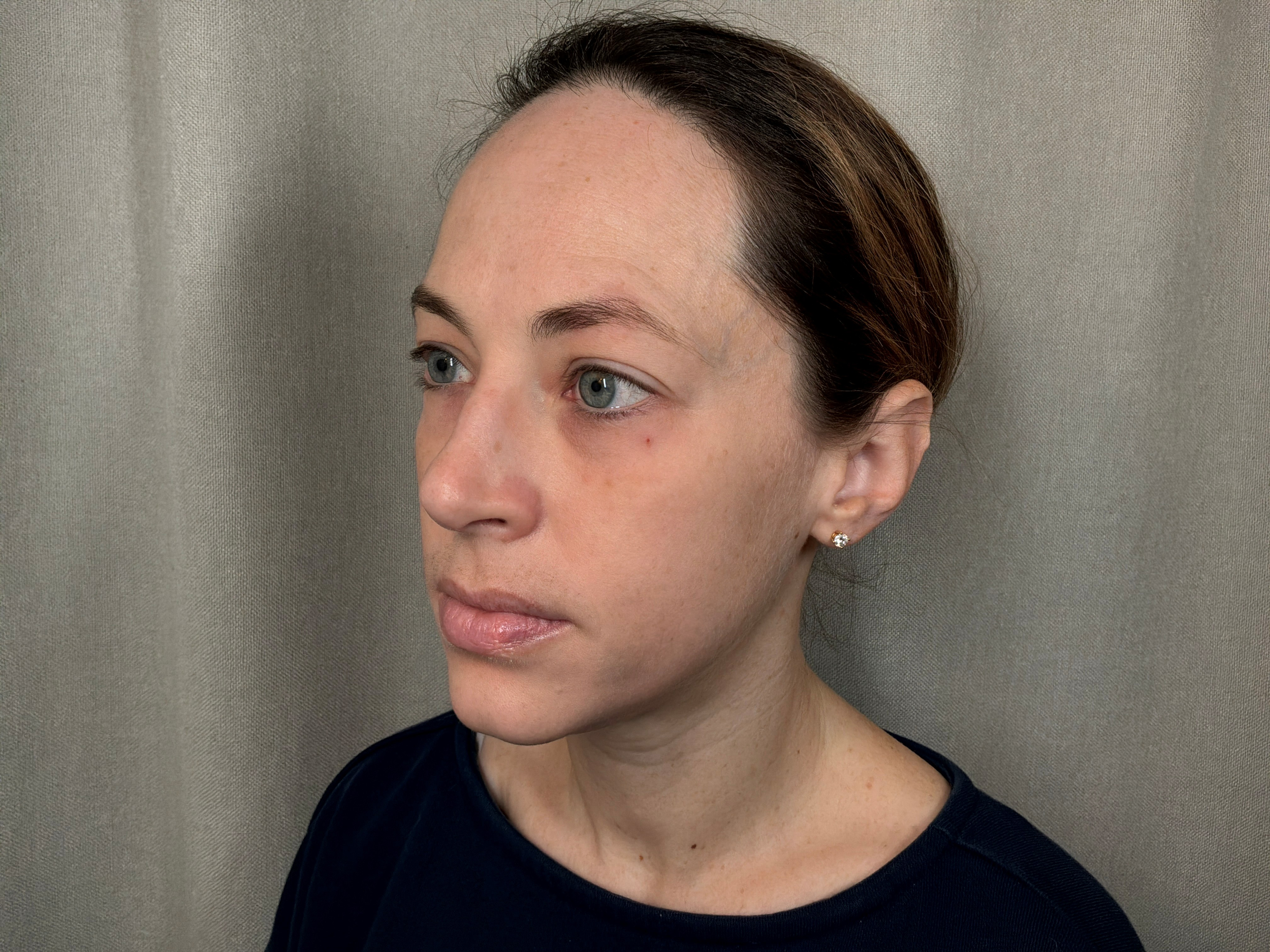 Before treatment