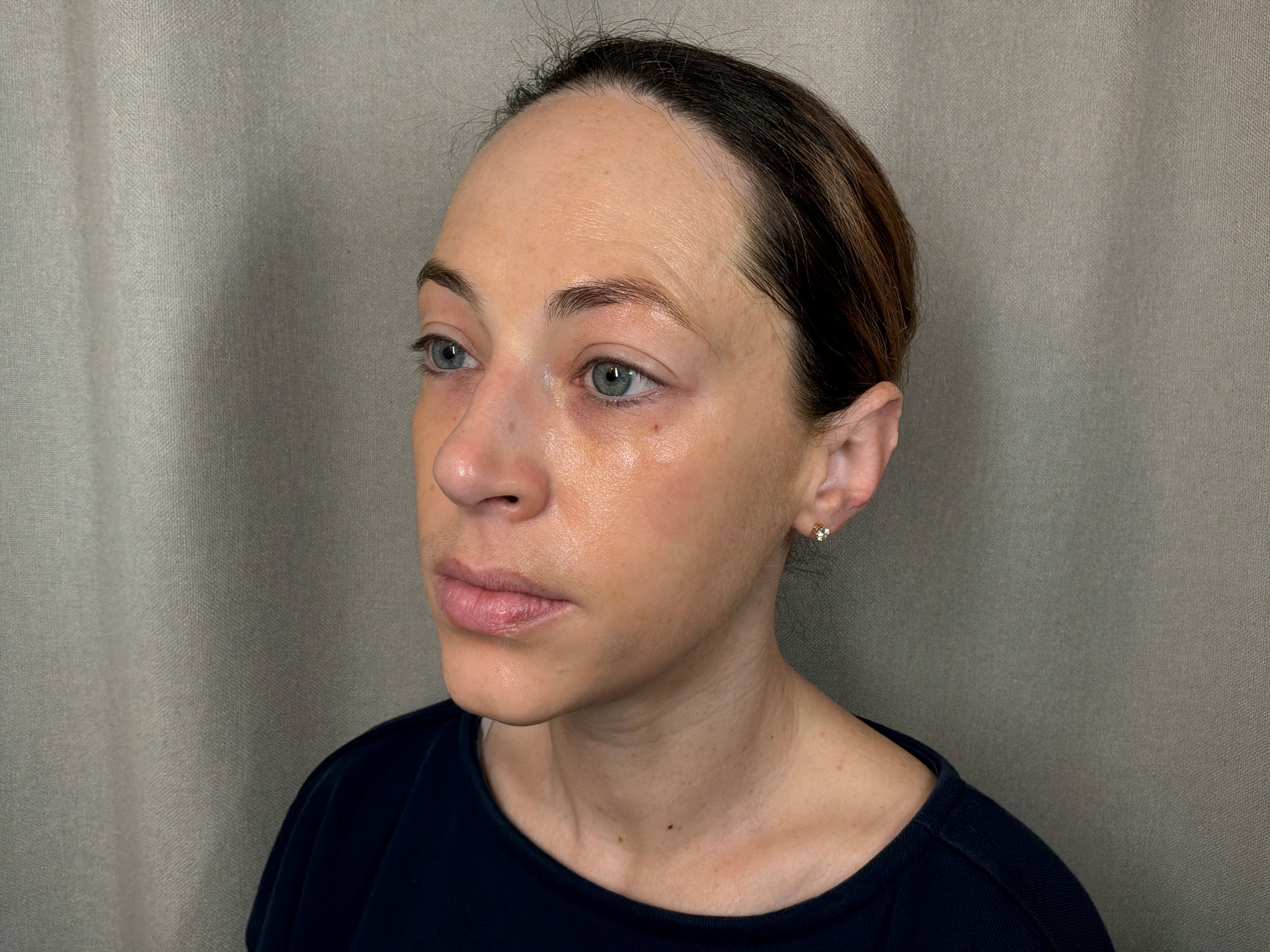 After treatment