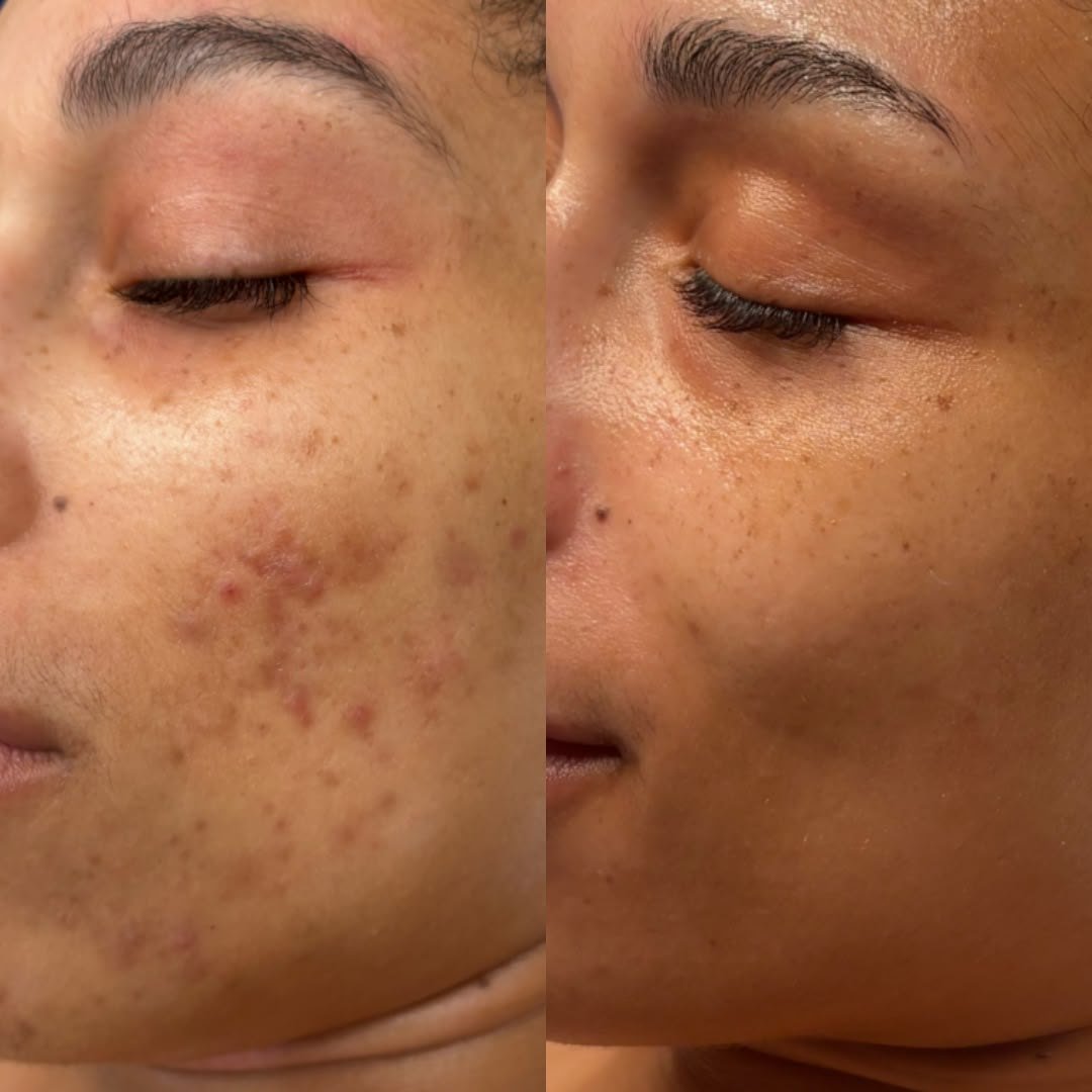 Clear cheek after the Acne Bootcamp
