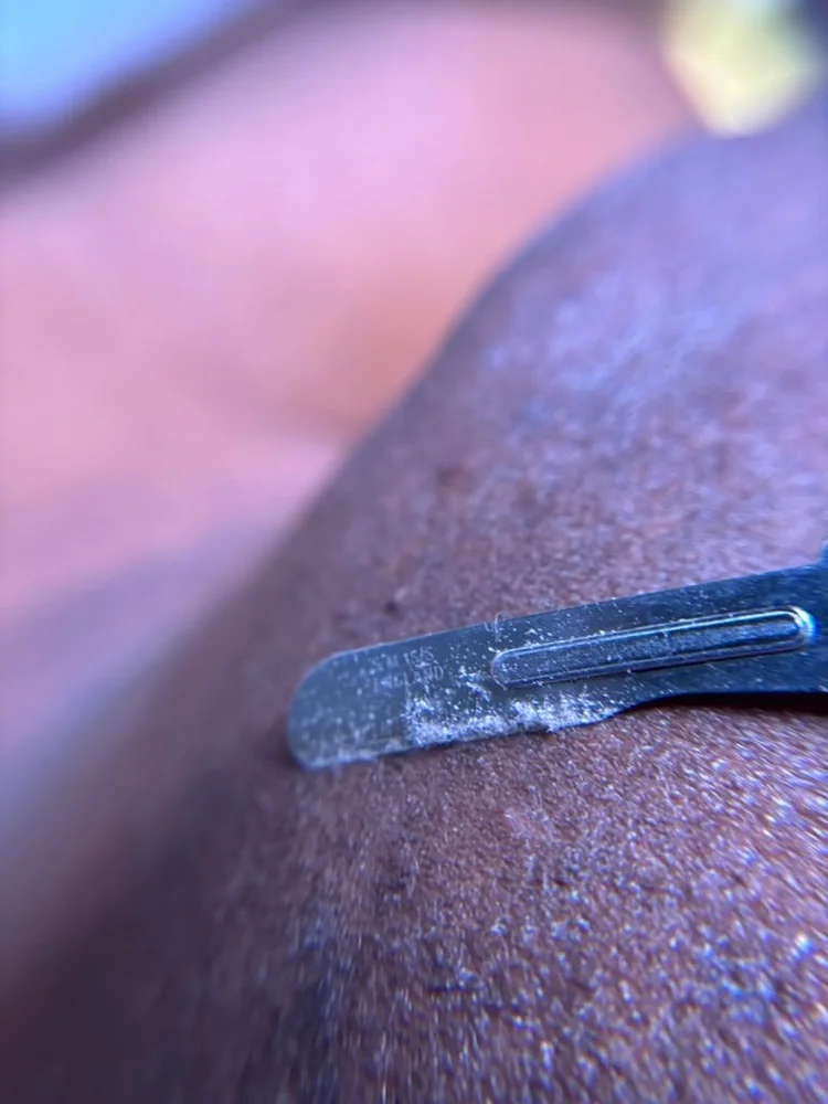 A dermaplaning blade lifting dead skin and peach fuzz