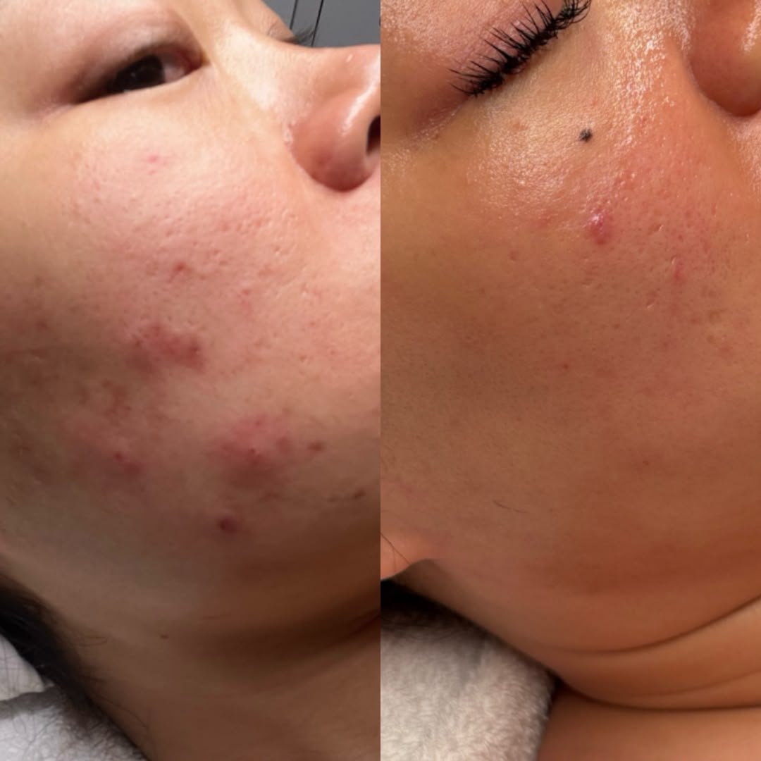 Clearer jaw after the Acne Bootcamp