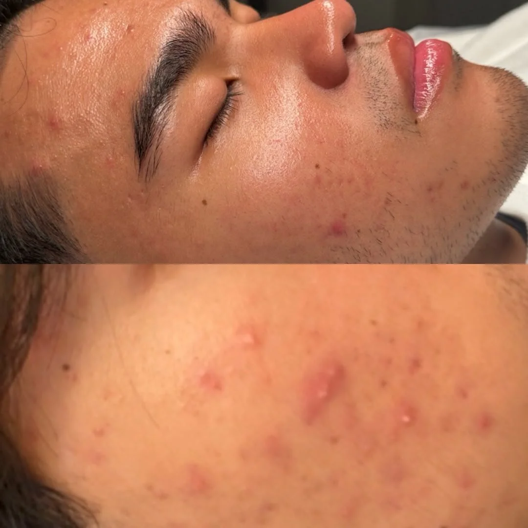 Clearer skin after the Acne Bootcamp