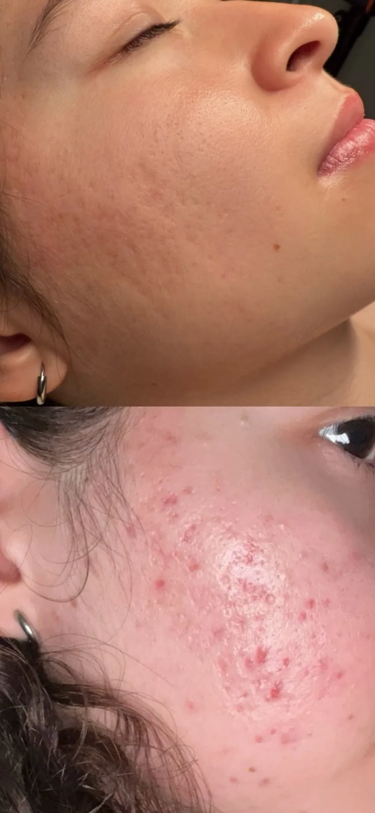 Before microneedling