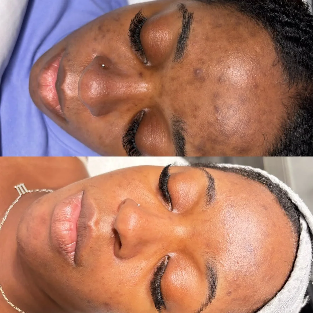 Before a chemical peel