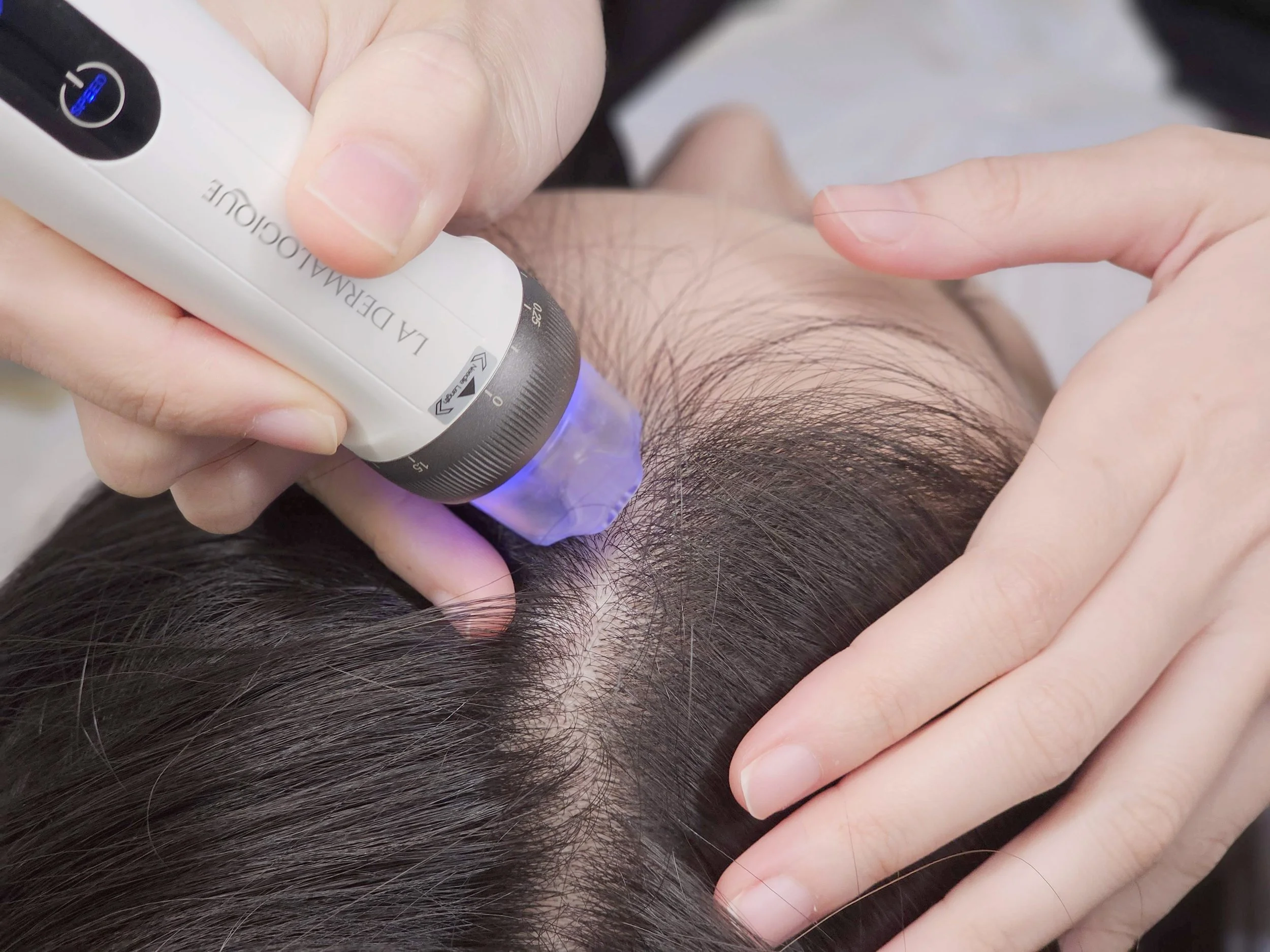 Actual Hairline Regrowth Microneedling treatment process