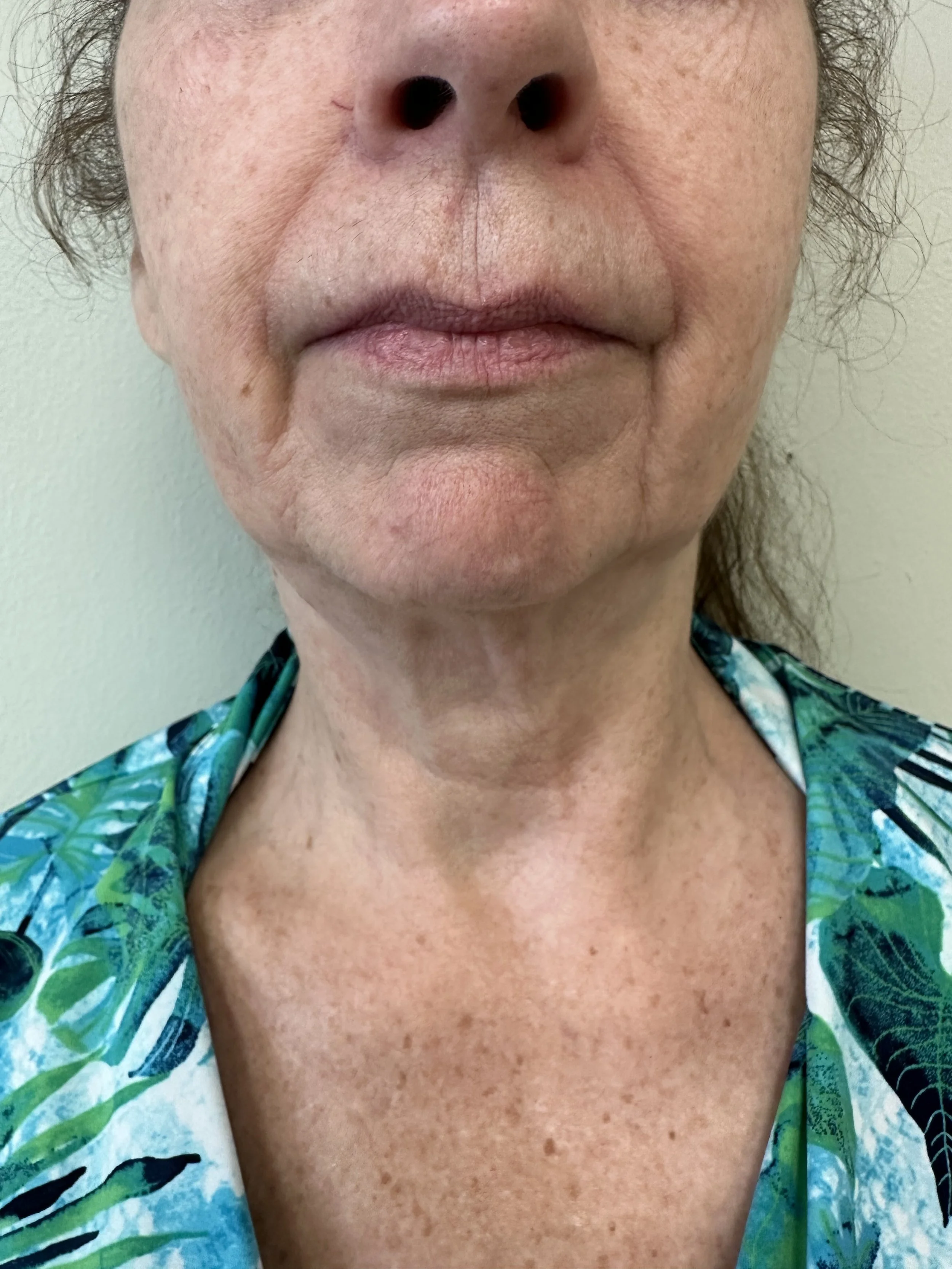 Lower face and neck before Mini Facelift and Liposuction