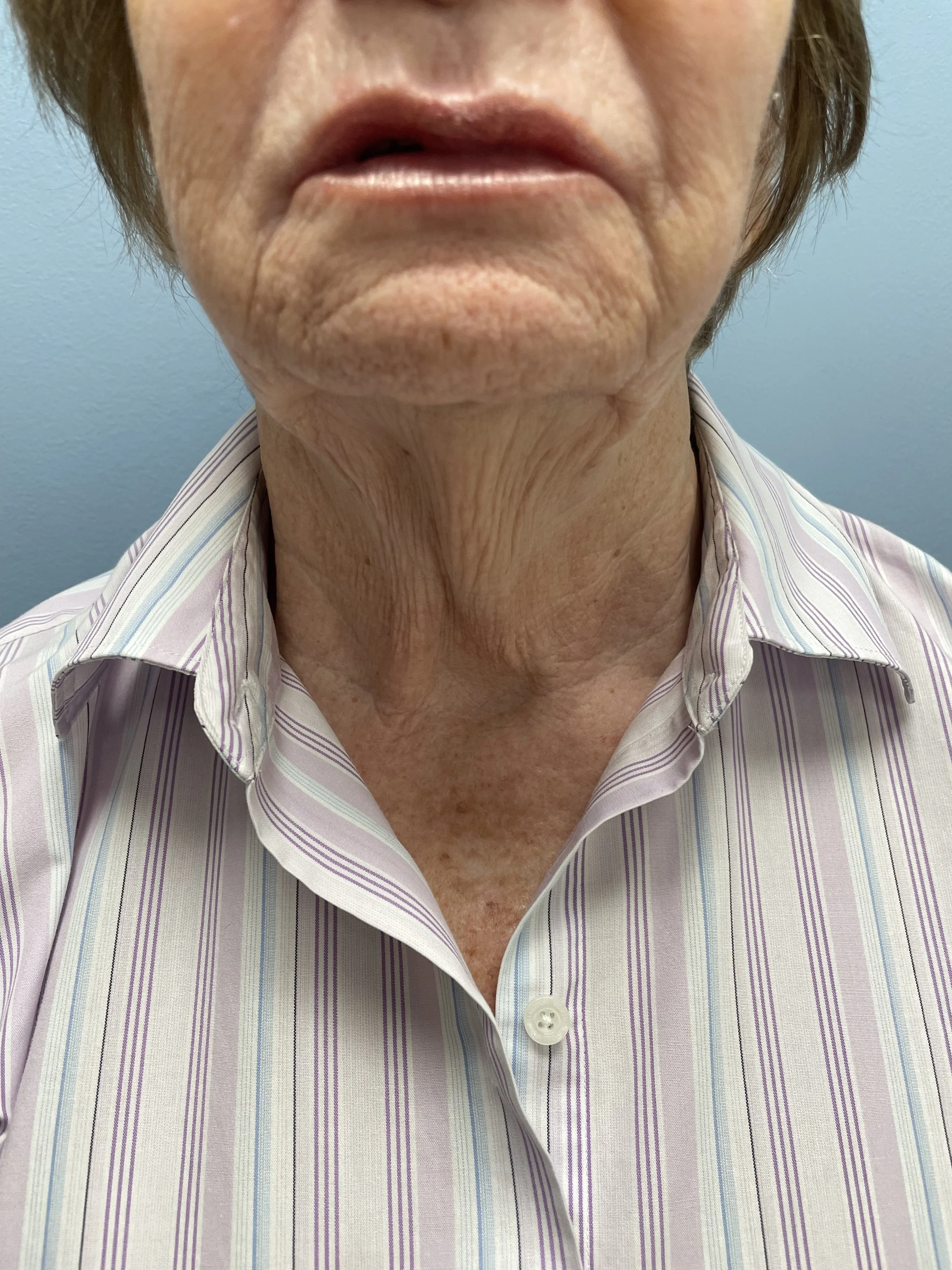Neck area before Mini Facelift