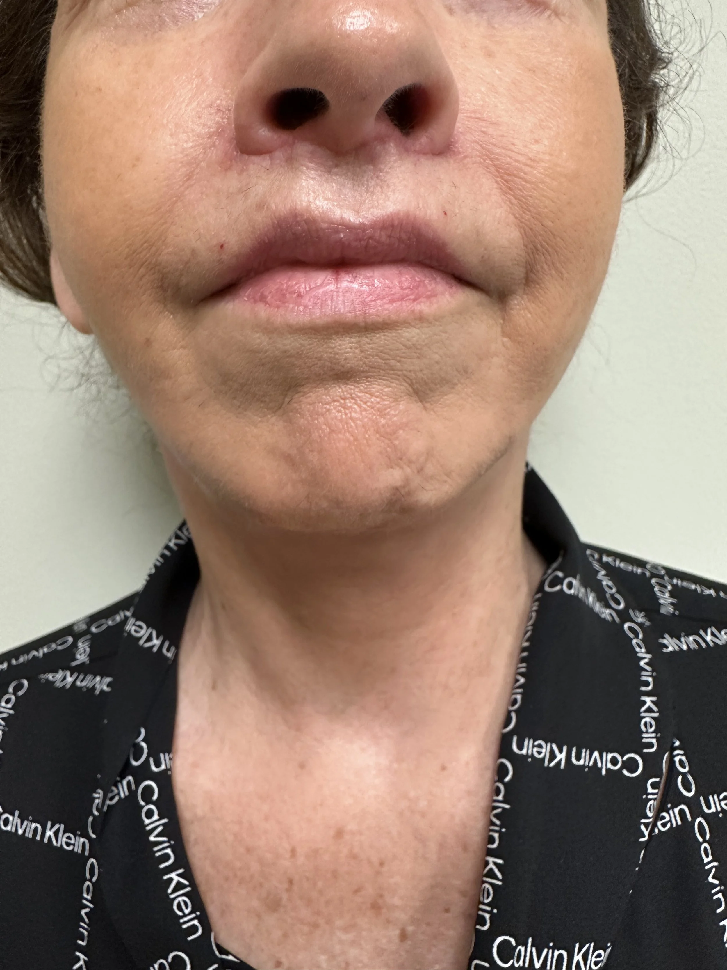 Lower face and neck after Mini Facelift and Liposuction