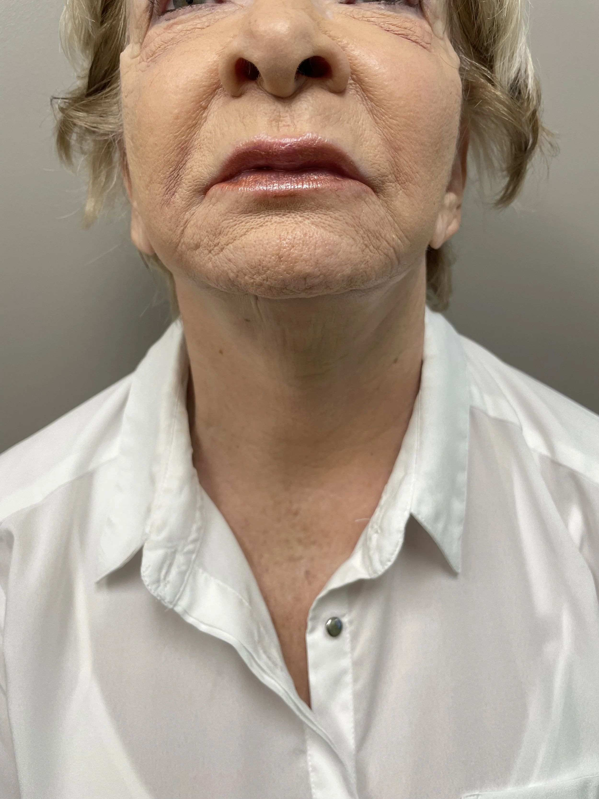 Neck area after Mini Facelift