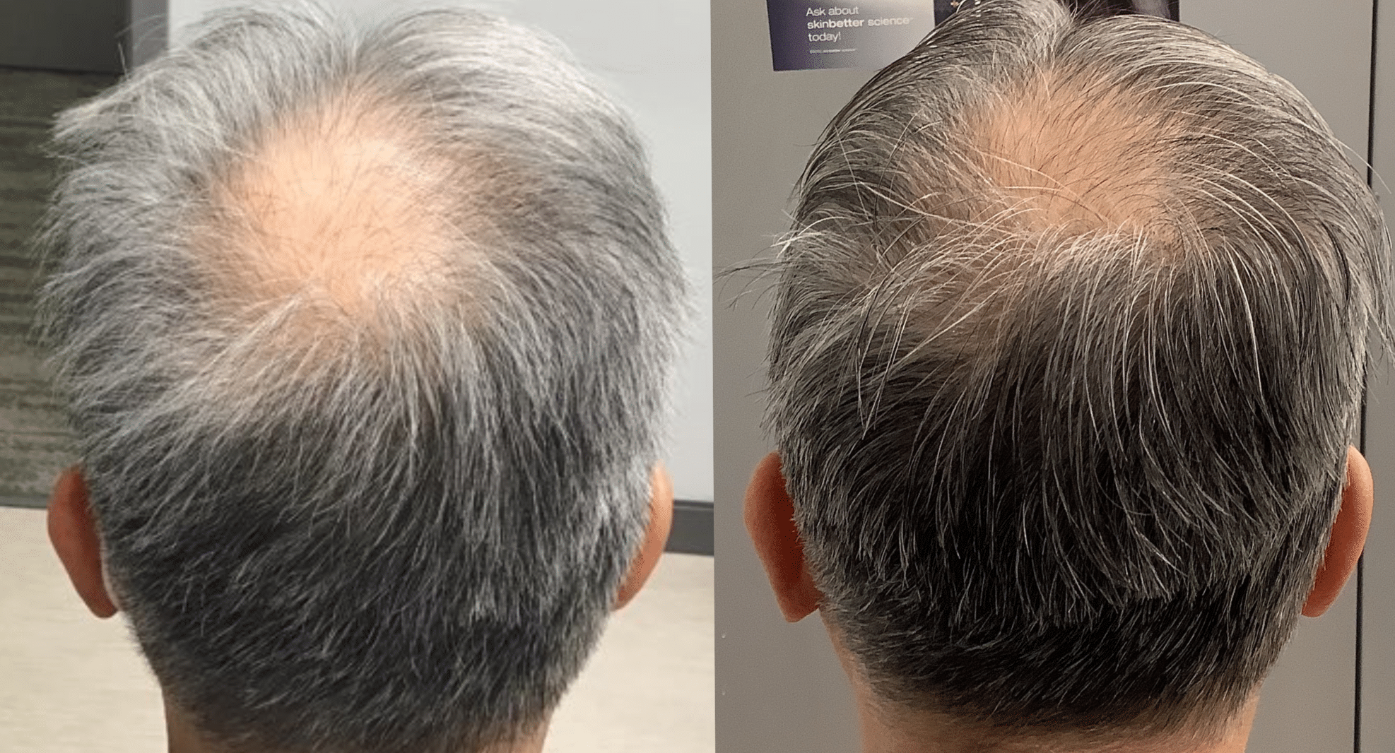Before and after hair thinning results at Another Look Hair Institute