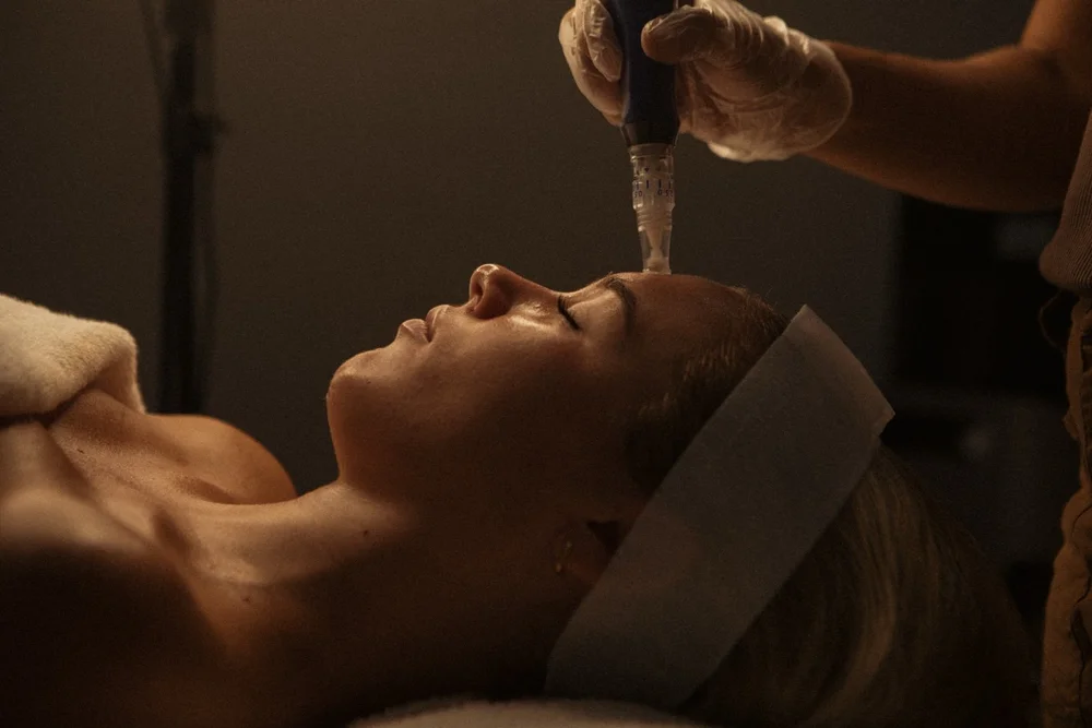 SkinPen skin needling treatment at Great Face in Ascot