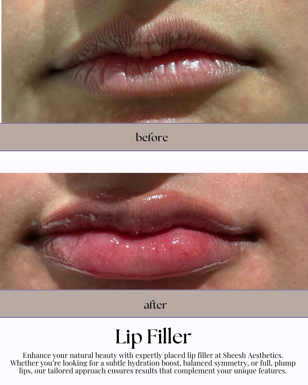 Lip filler results