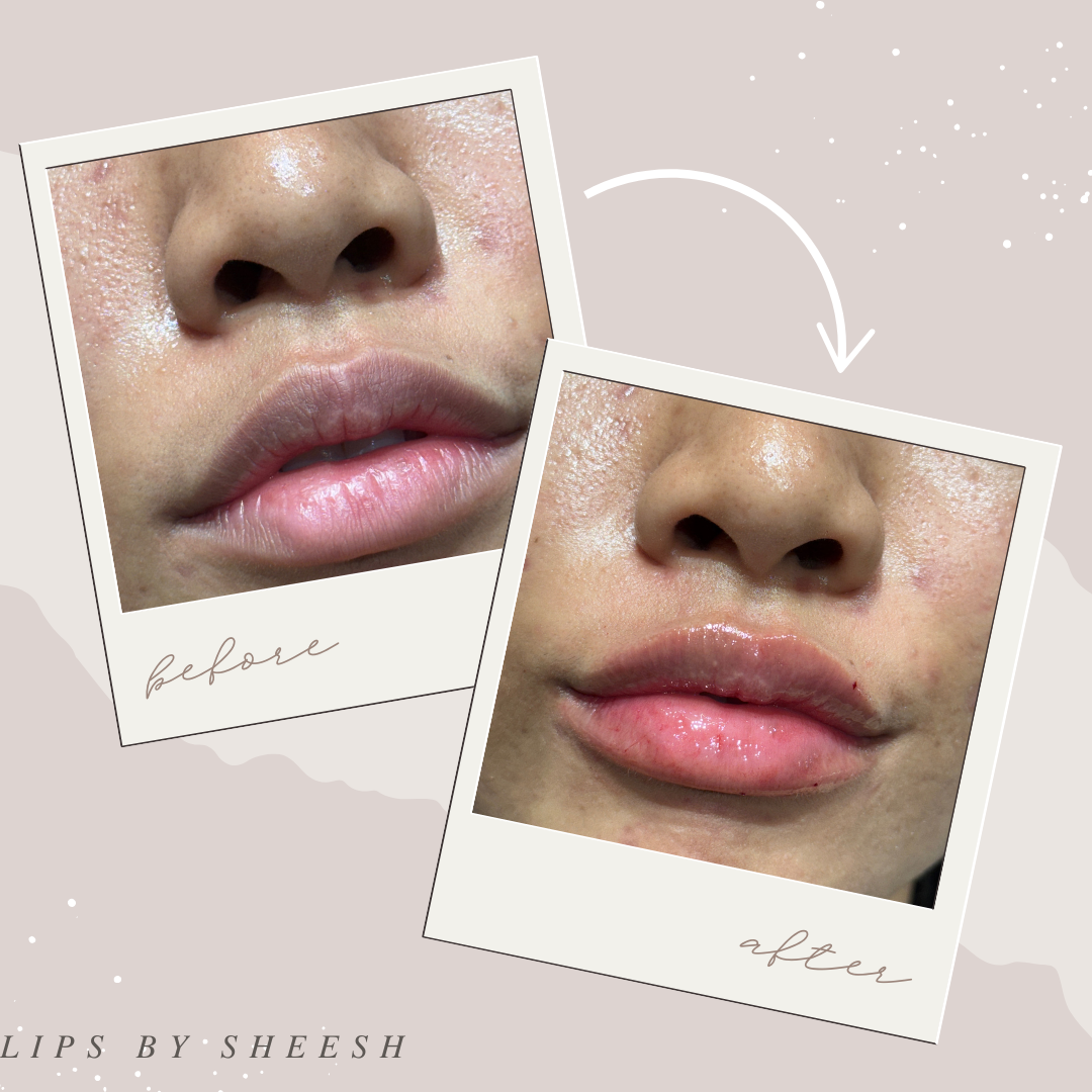 Lip filler results