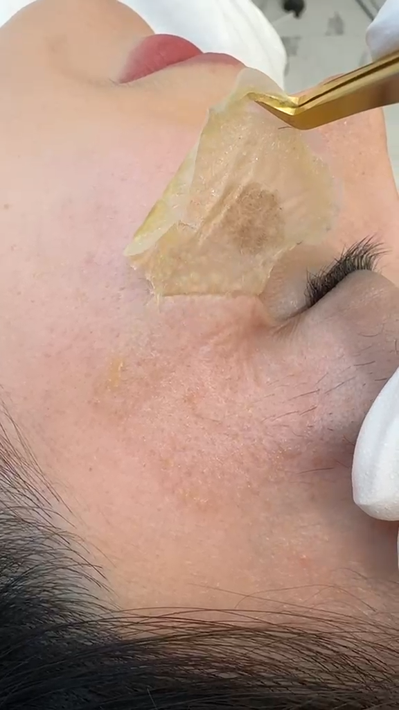 Close-up of a dressing being lifted during the MELACLEAN treatment process