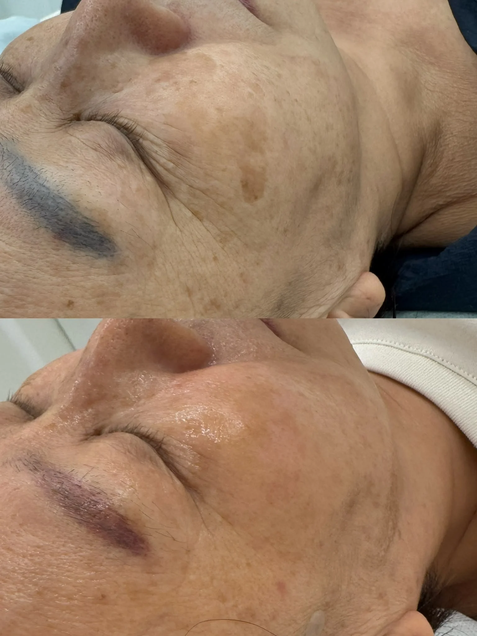 MELACLEAN treatment photographs showing two views of the cheek