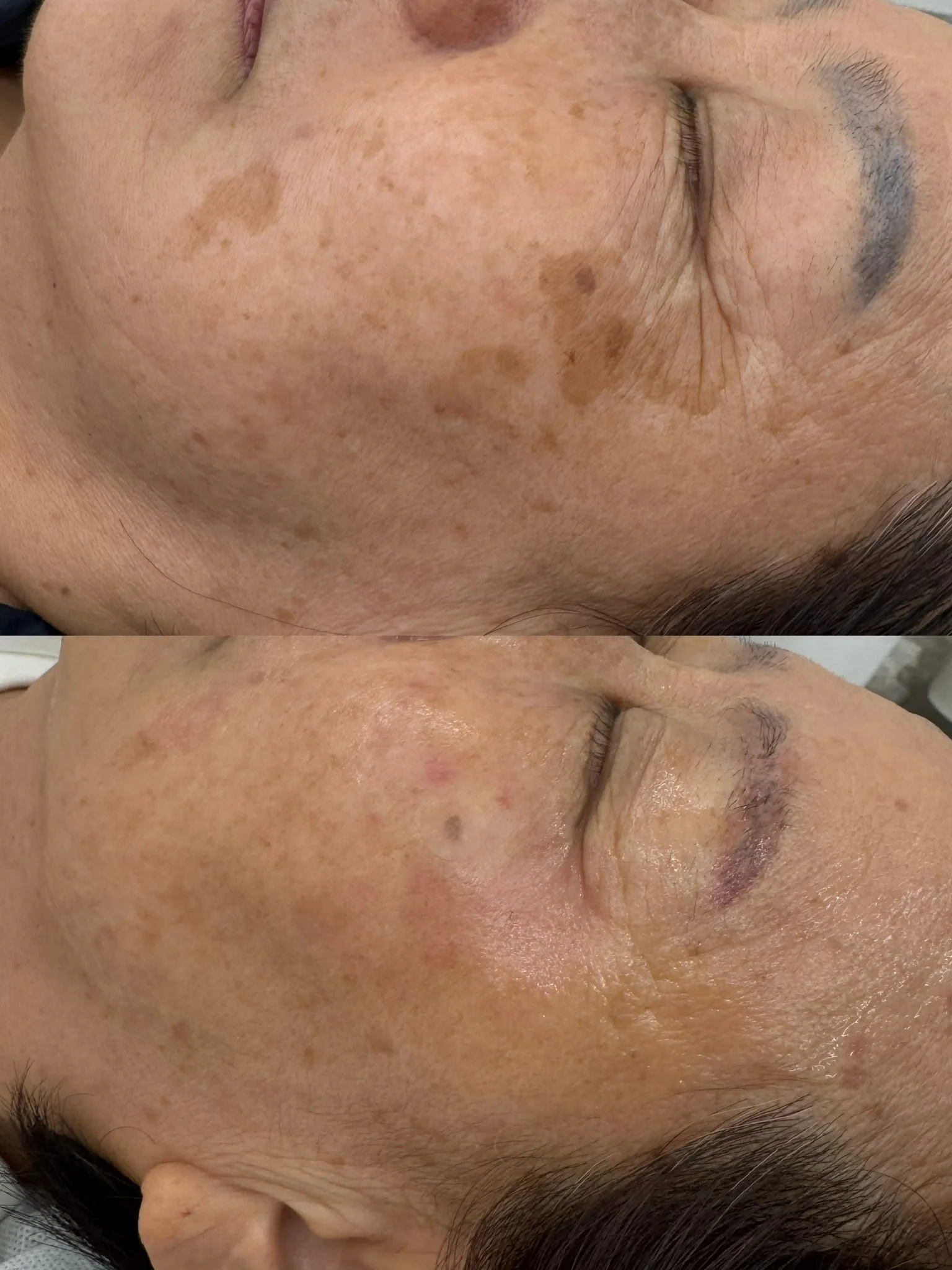 MELACLEAN treatment photographs showing the opposite cheek