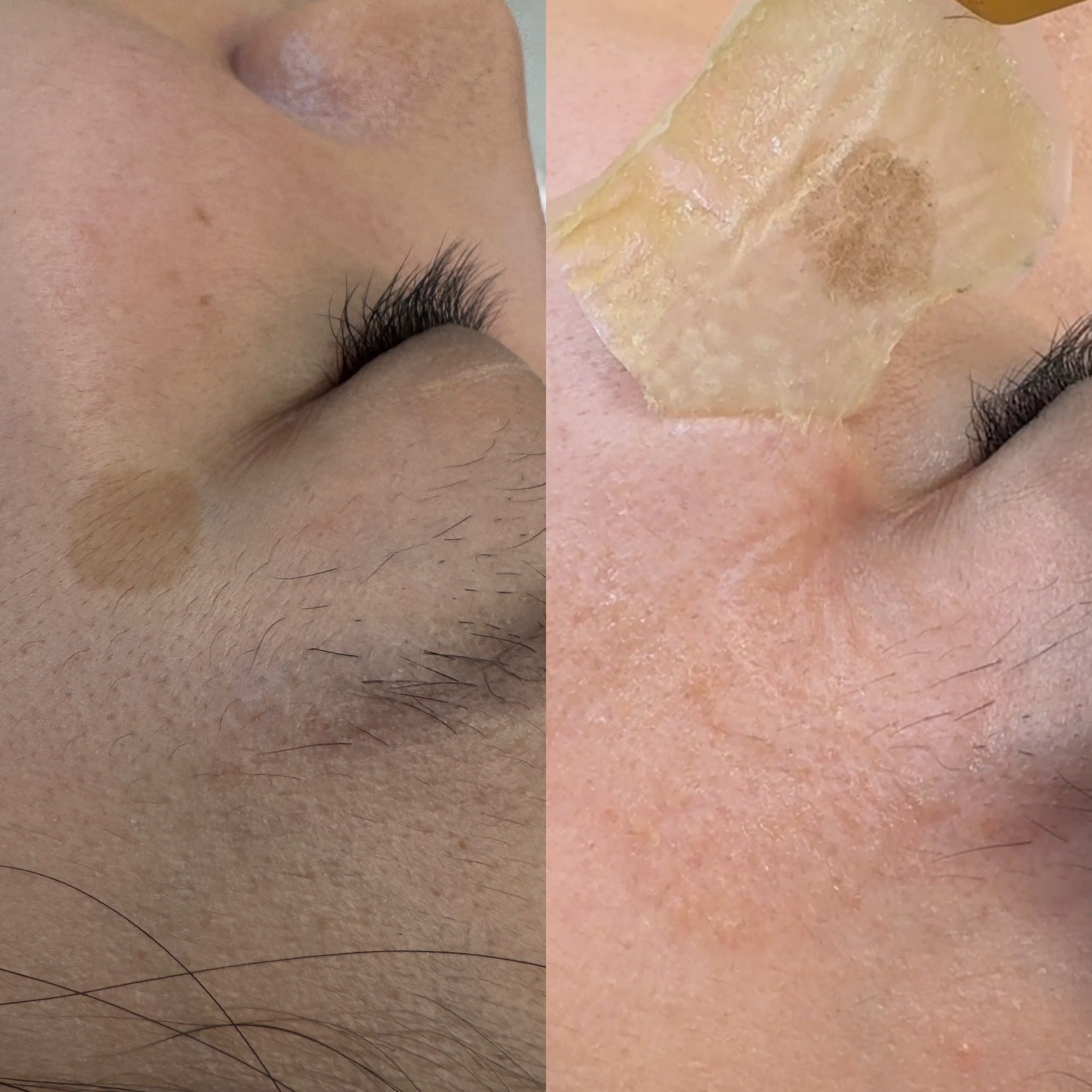 Close-up treatment comparison with a dressing over the cheek area