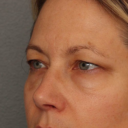 eyelids