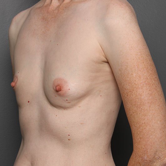 fat injection