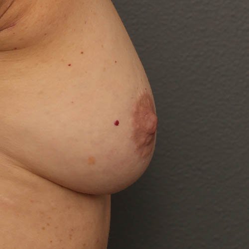 breast aug