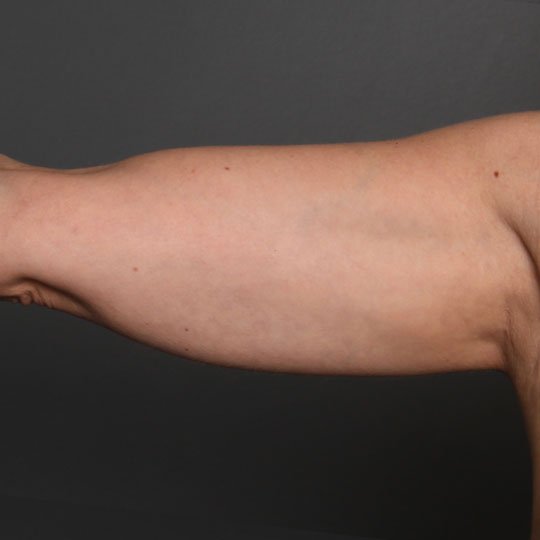 fat injection