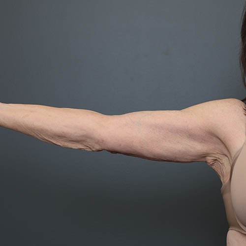 arms
