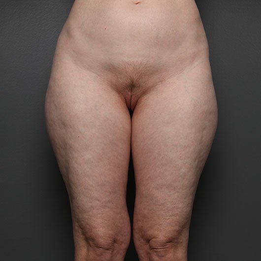 tummy tuck