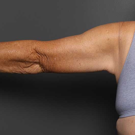 arms