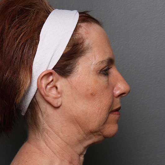 facelift