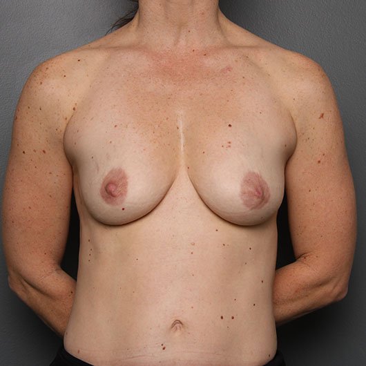 nipples