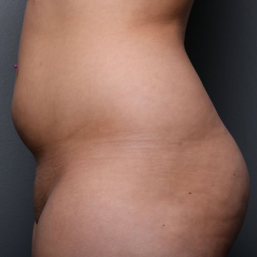 liposuction