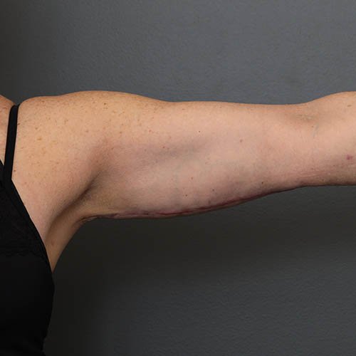 arms
