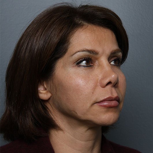 liplift