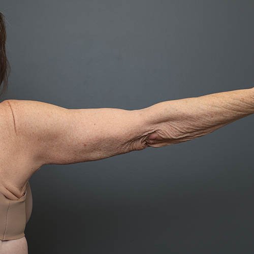 Liposuction