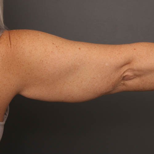 arms