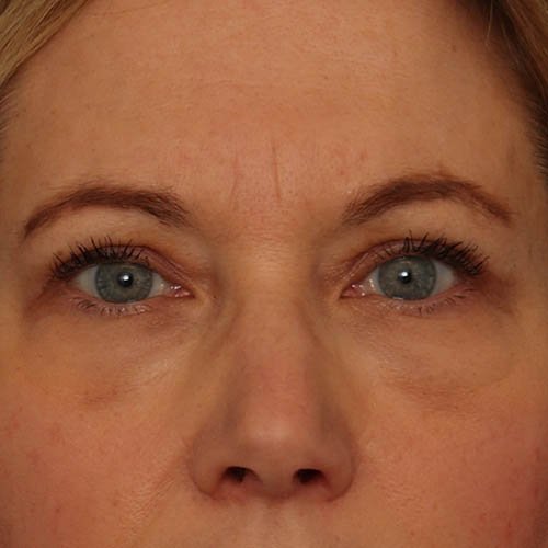 eyelids