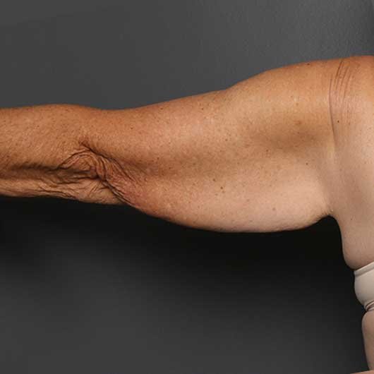 arms