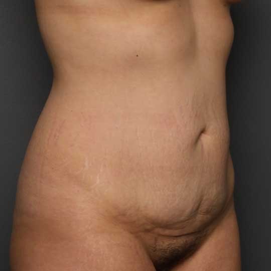 tummy tuck