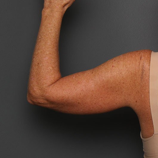 arms