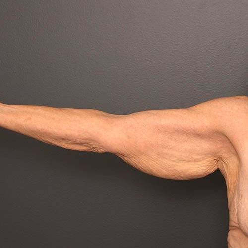 arms